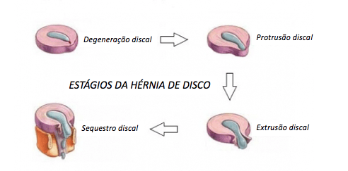 Cirurgia - Hernia de disco