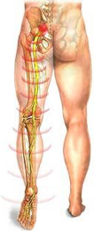 Cirurgia - Hernia de disco