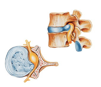 Cirurgia - Hernia de disco